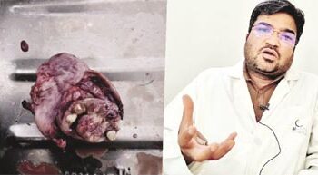 الشفا ہاسپٹل نے پیٹ میں پنپ میں رہی گانٹھ جس میں انسانی دانت نکل آئے تھے کا کامیاب آپریشن کیا