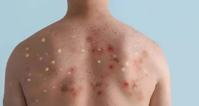 جنوبی افریقہ میں منکی پاکس کے پانچ کیسز کی تصدیق کے بعد ہائی الرٹ