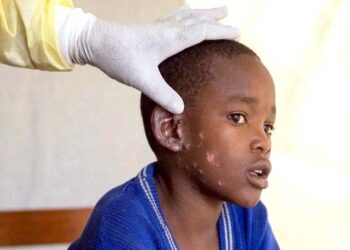 کانگو میں رواں برس ’منکی پاکس‘ سے 548 افراد ہلاک