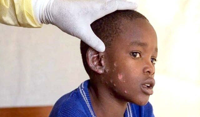 کانگو میں رواں برس ’منکی پاکس‘ سے 548 افراد ہلاک