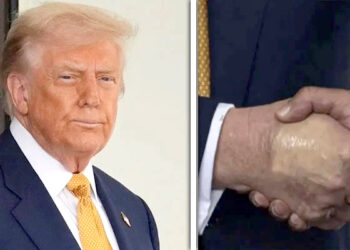 ٹانگوں اور ٹخنوں پر سوجن، ہاتھوں پر نیل، ٹرمپ خطرناک بیماری میں مبتلا