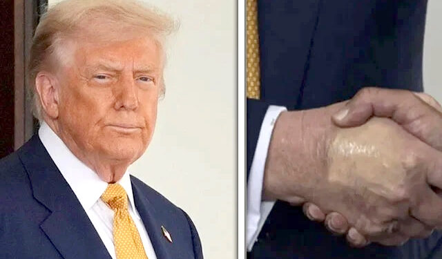 ٹانگوں اور ٹخنوں پر سوجن، ہاتھوں پر نیل، ٹرمپ خطرناک بیماری میں مبتلا